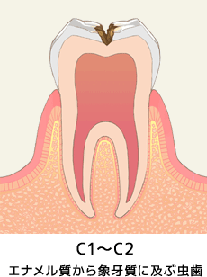 C1～C2　エナメル質から象牙質に及ぶ虫歯