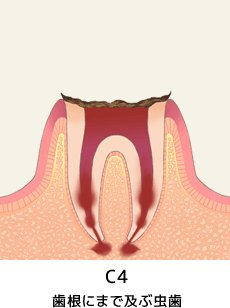 C1～C2　エナメル質から象牙質に及ぶ虫歯